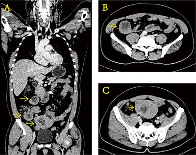 Case report: Ewing sarcoma with EWSR–ERG fusion elevates procalcitonin extremely in the long term without infection